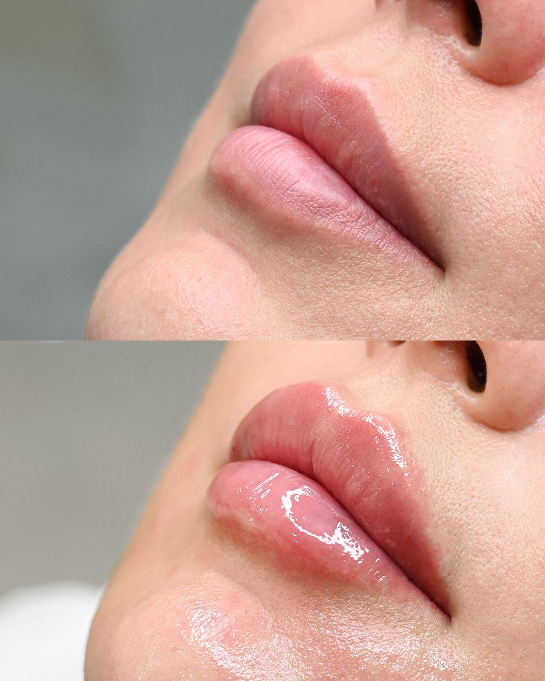 Labios después del tratamiento
