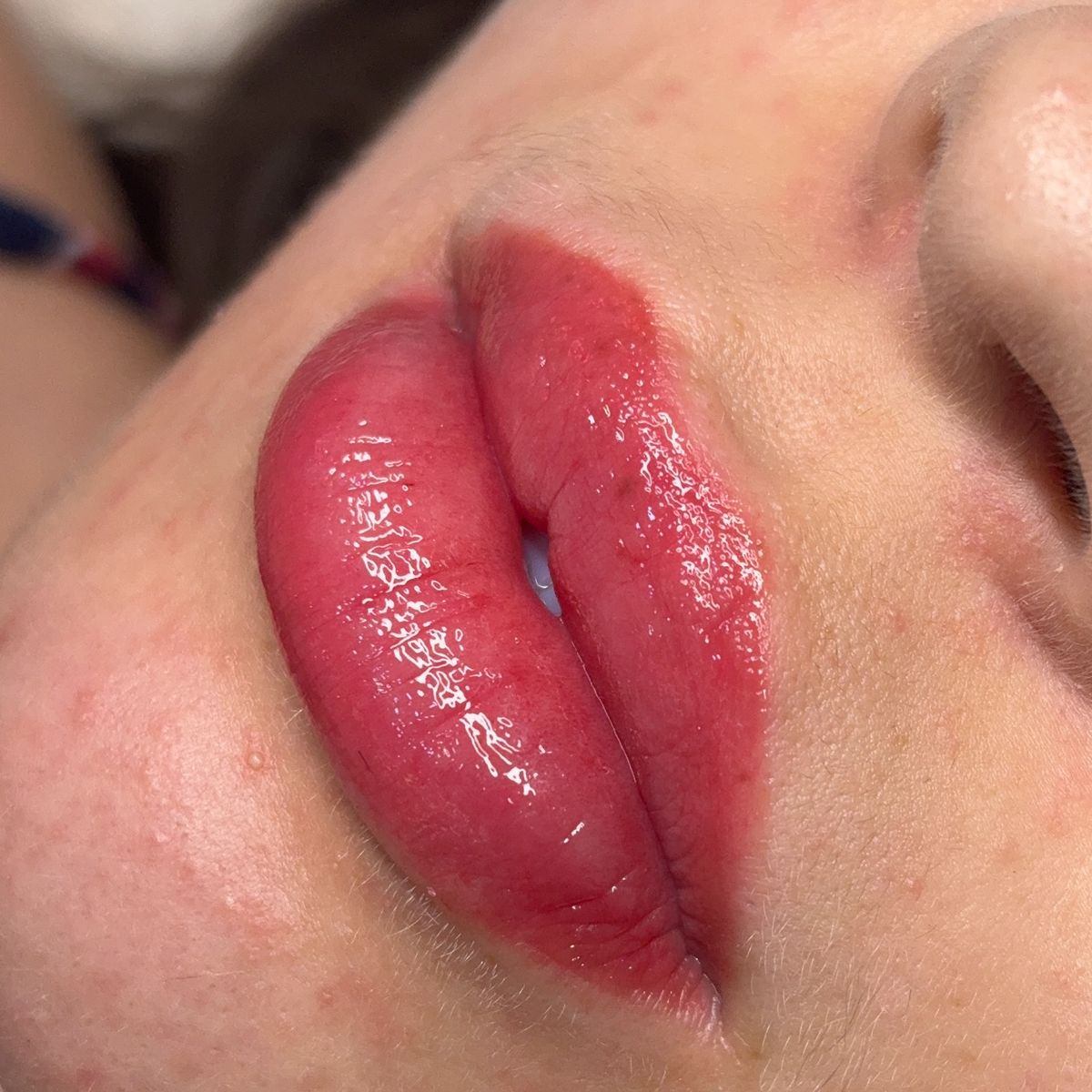 Labios antes del tratamiento