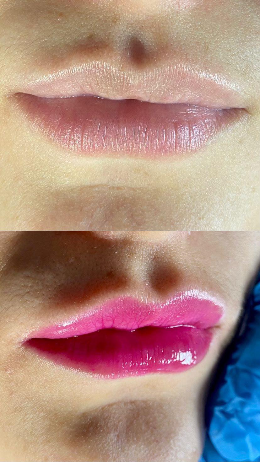 Labios después del tratamiento