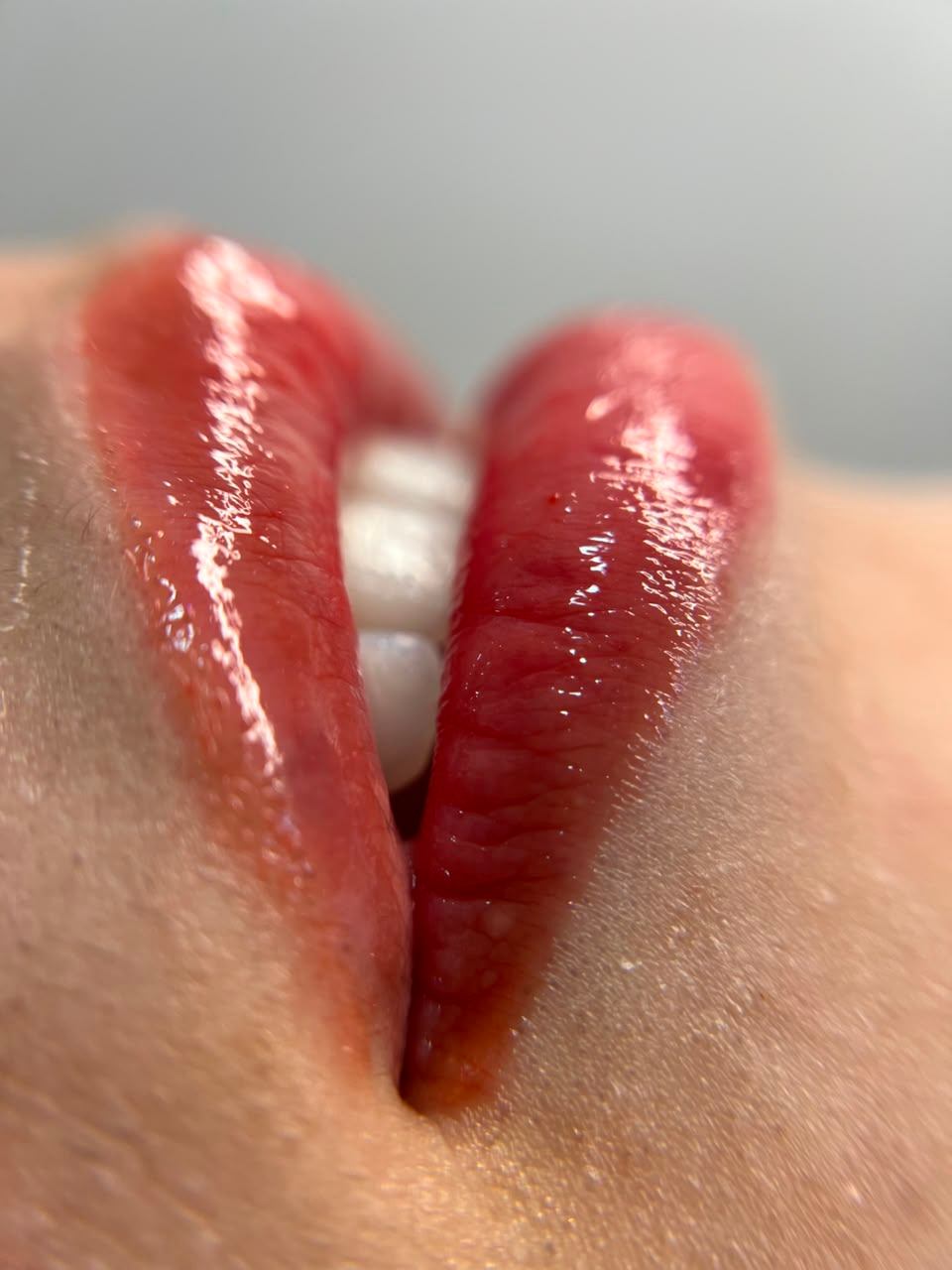 Labios antes del tratamiento