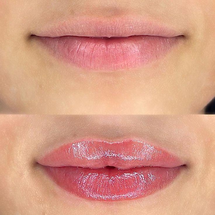 Labios después del tratamiento