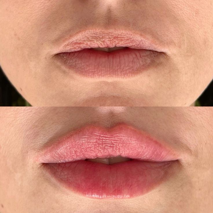 Labios antes del tratamiento